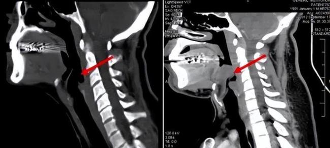 近期高发的嗓子疼,或是一种凶险的急症